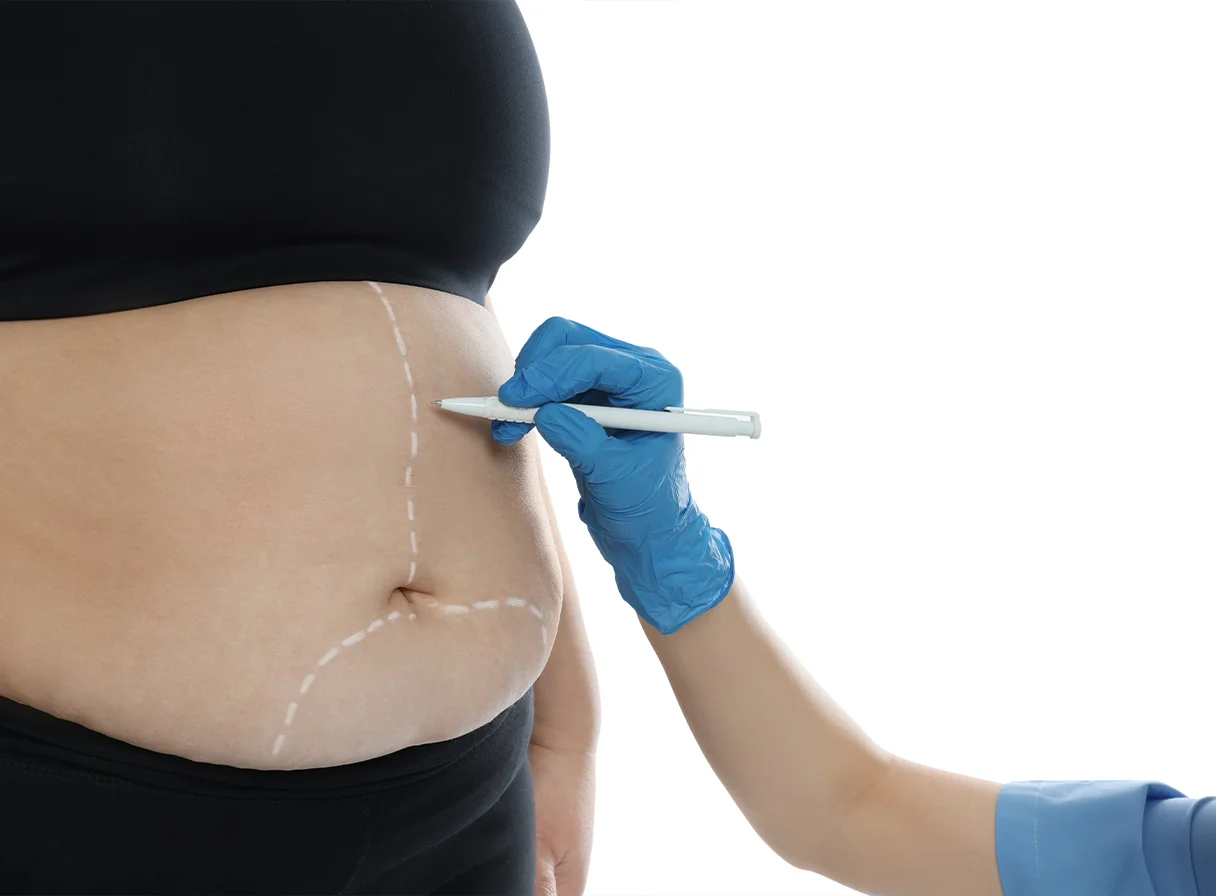 What is Bariatric Surgery? A Complete Guide to Weight Loss Surgery